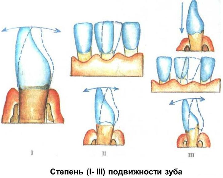 Определите степень подвижности зубов Определите степень подвижности зубов